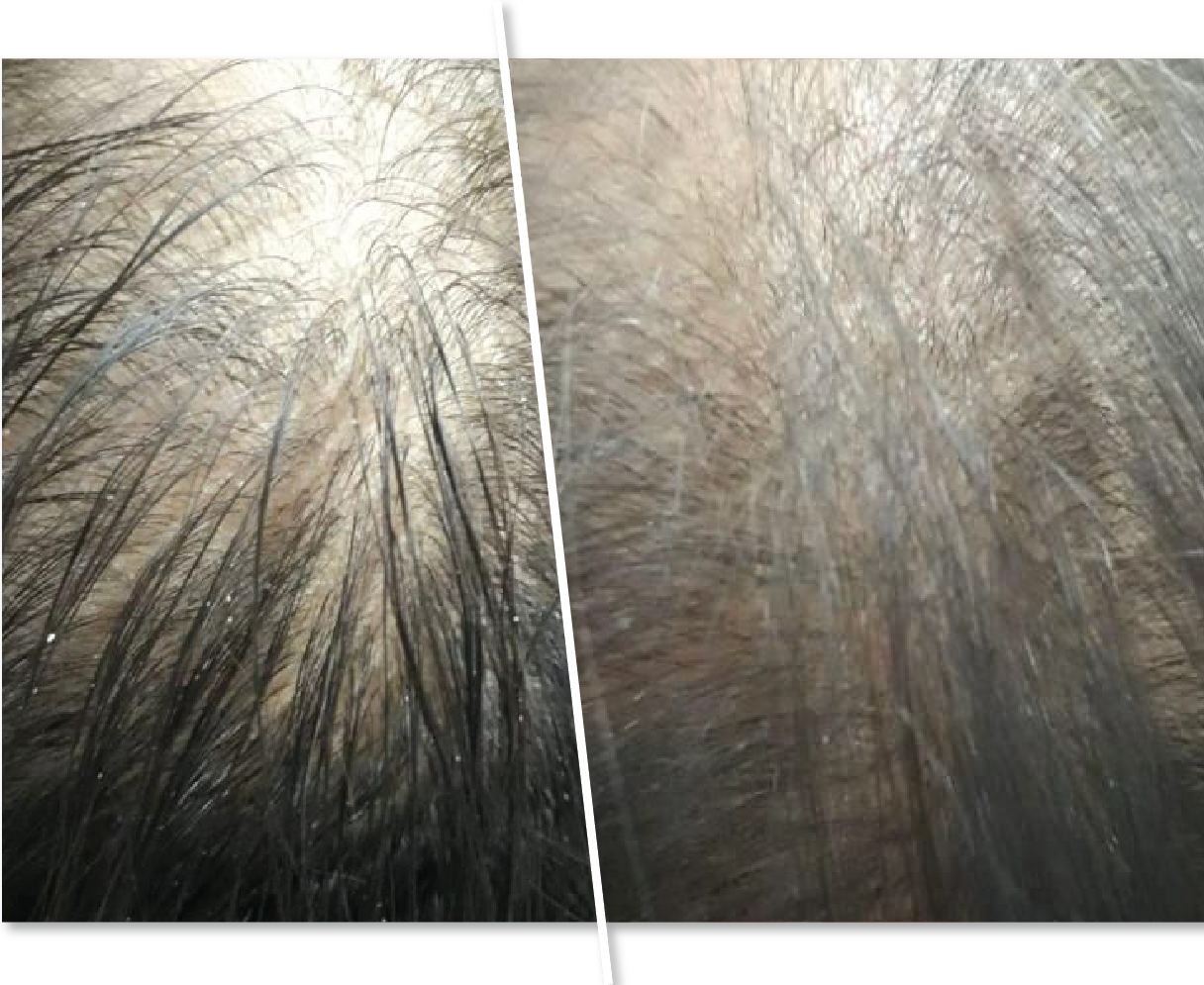 Dandruff Before and After Treatment