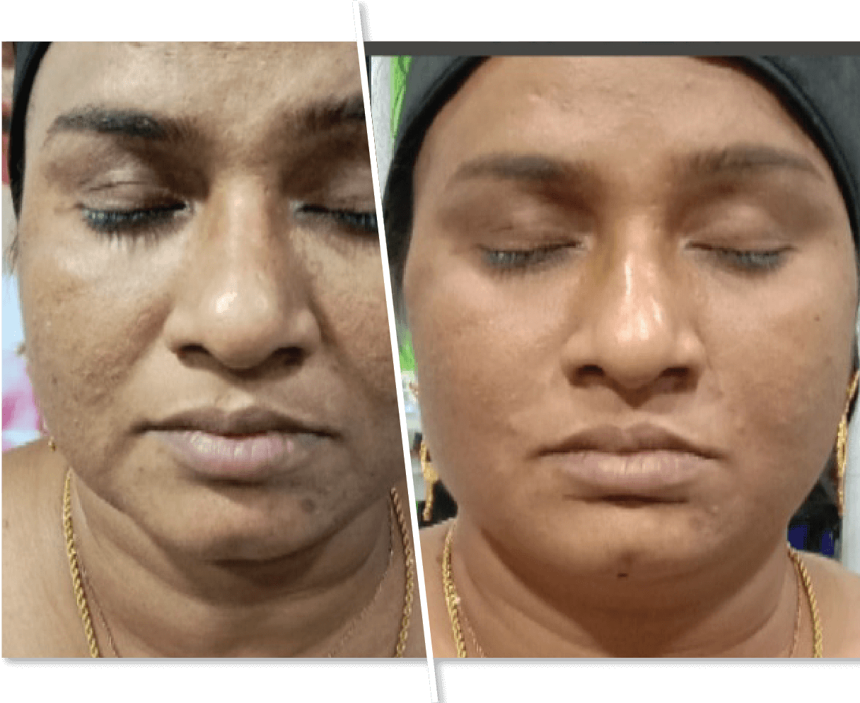 Women Before and After Dark Spots Removal