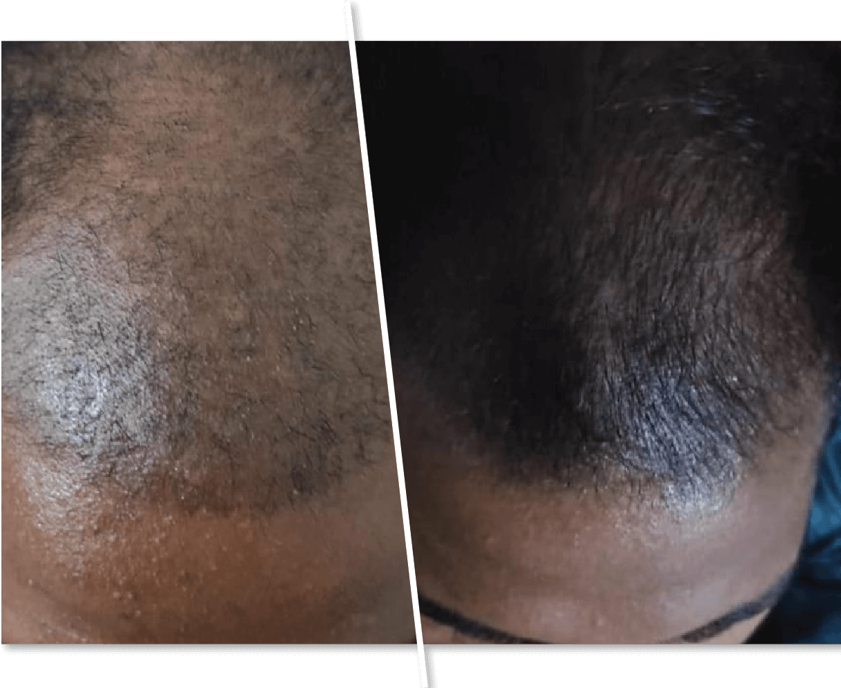 Hair Transplantation Clinic in Hyderabad, Chennai, Bangalore Hair Transplantation Clinic in Hyderabad, Chennai, Bangalore
