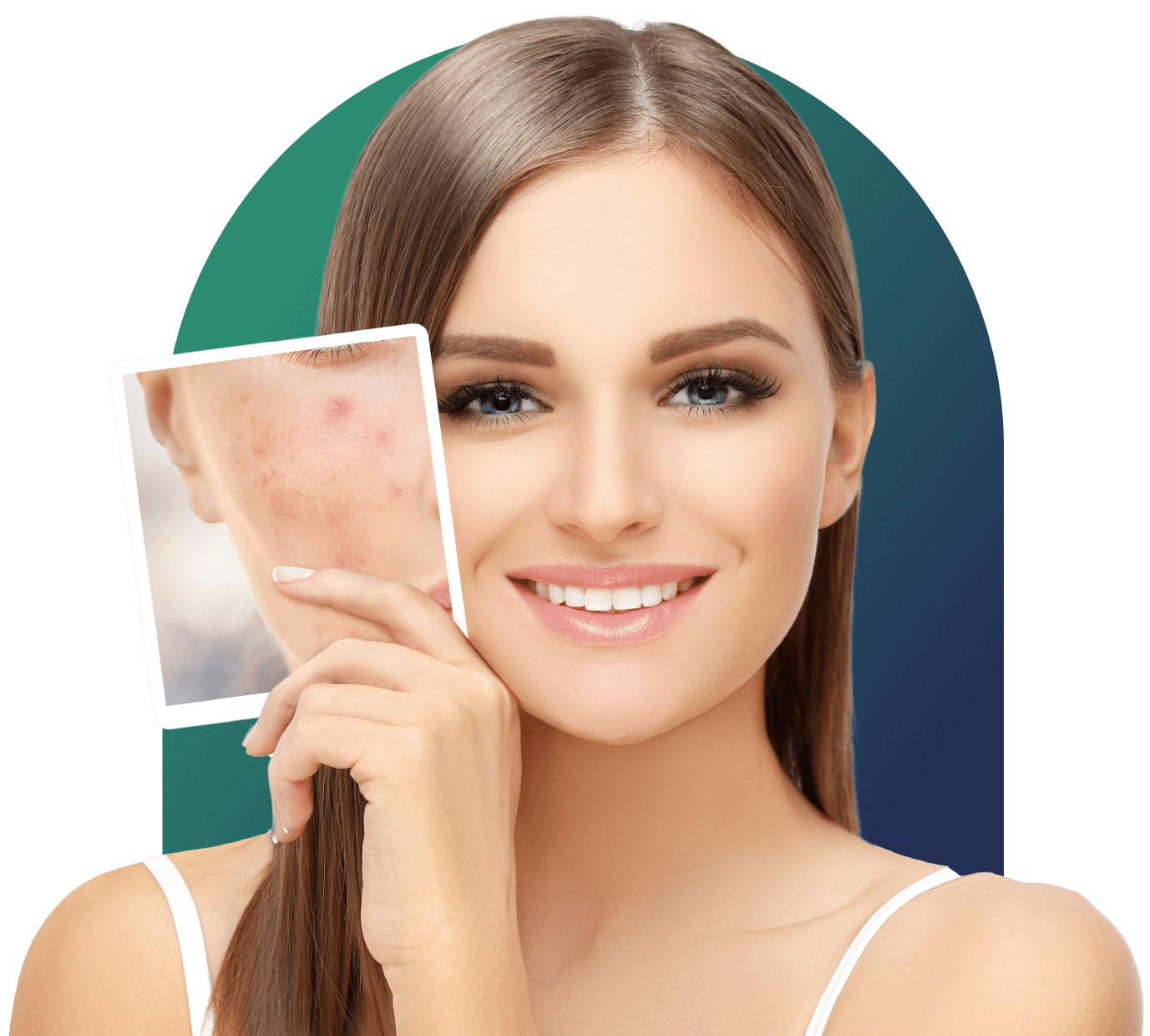 Image showcasing Natural Acne Treatment, Scar Removal in Bangalore, Hyderabad
