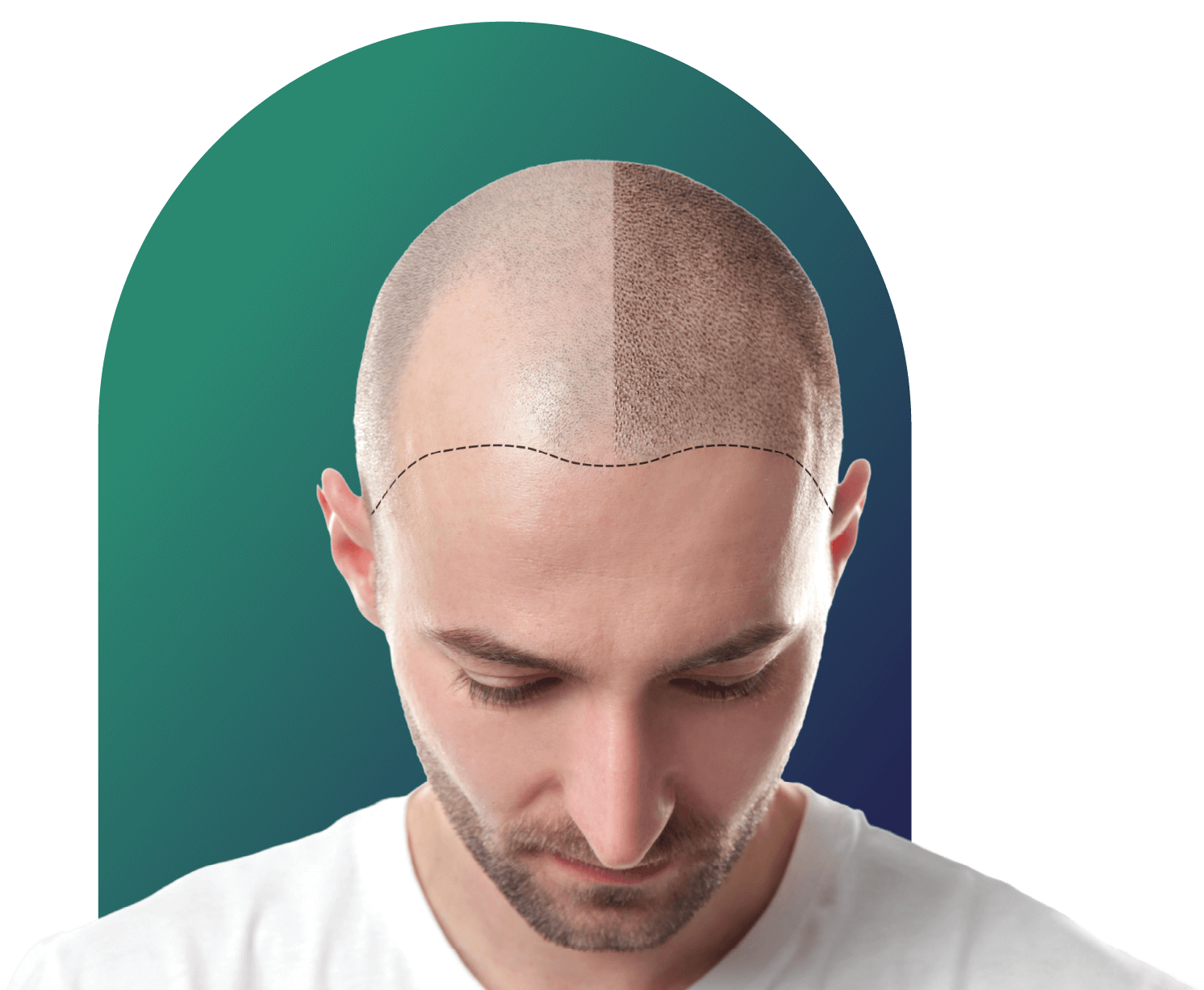 Hair Transplantation Clinic in Hyderabad, Chennai, Bangalore Hair Transplantation Clinic in Hyderabad, Chennai, Bangalore