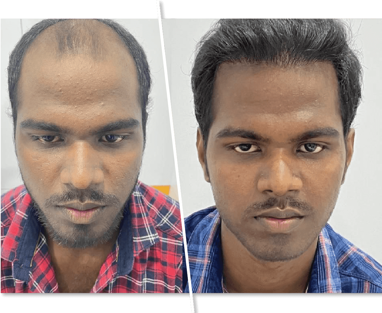 Before and after hair transplant StepbyStep Situation  RepHair