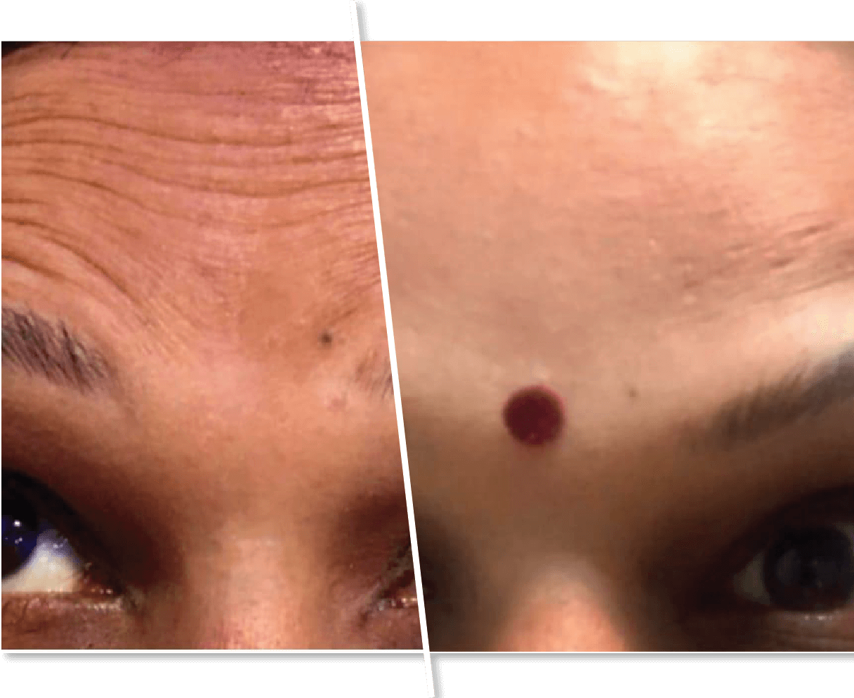 Woman Wrinkles Before and After Treatment