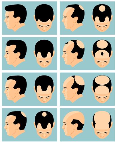 Hair Transplantation - Kolors Healthcare India Hair Transplantation - Kolors Healthcare India