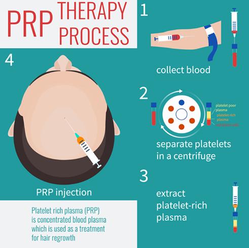 About PRP and Cosmetic Hair Replacement Treatment - Kolors Healthcare India