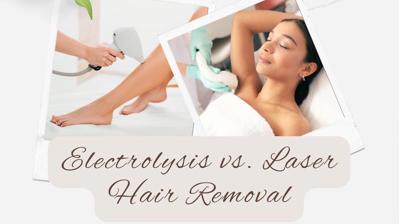 Electrolysis vs. Laser Hair Removal: Which Is Best?