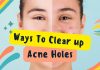 Acne Holes Scarring