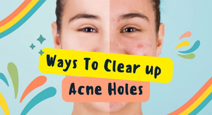 Acne Holes Scarring