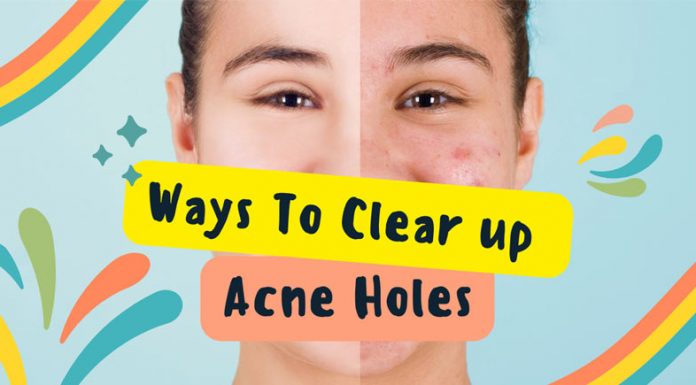 Acne Holes and Scarring on the Face: Types, Therapy, Cost Acne Holes Scarring