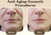 Top 4 Anti-Aging Cosmetic Procedures for Women over 50 Anti Aging Cosmetic Procedures Women Before After