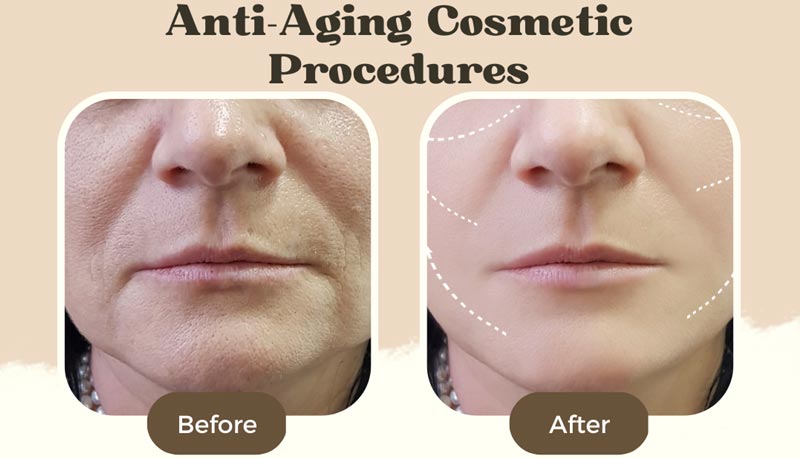 Top 4 Anti-Aging Cosmetic Procedures for Women over 50