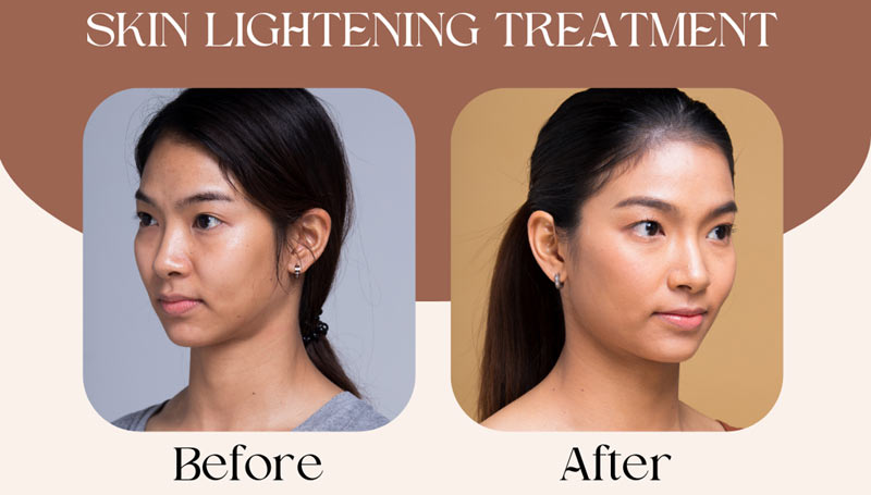 Skin Lightening Treatment Before After