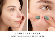 Comedonal Acne Symptoms Causes Treatment