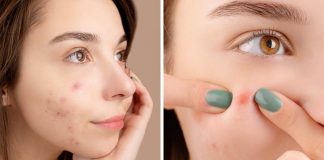 Comedonal Acne Symptoms Causes Treatment
