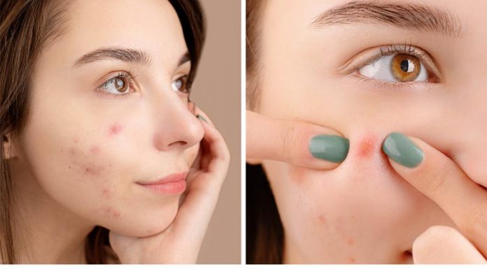 Comedonal Acne – Symptoms, Causes, Treatment, and Tips Comedonal Acne Symptoms Causes Treatment