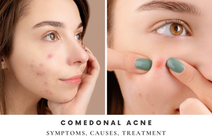 Comedonal Acne Symptoms Causes Treatment