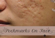 Pockmarks On Face