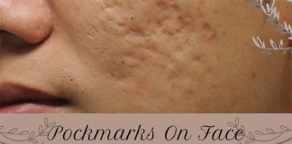 Pockmarks On Face