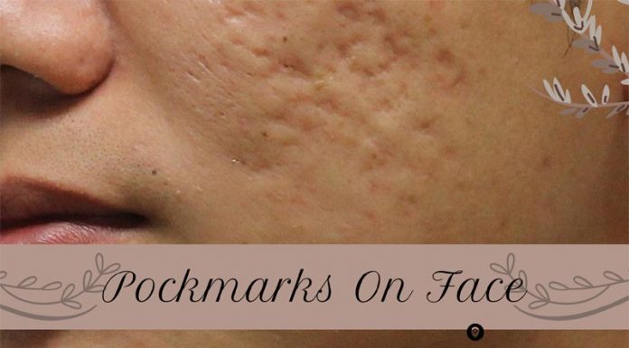 Pockmarks On Face