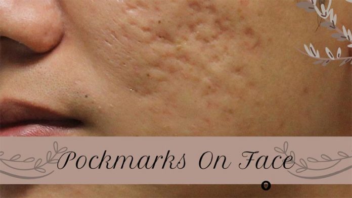Pockmarks On Face