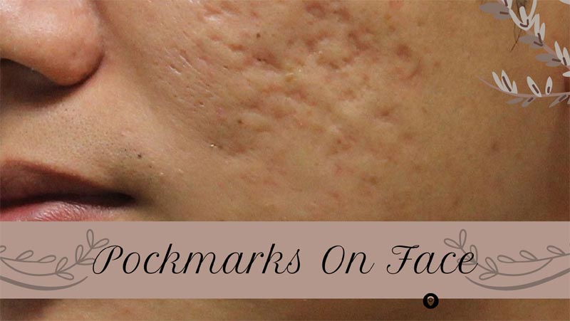 Pockmarks On Face Meaning Causes Best Treatments pockmarks-on-face-meaning-causes-best-treatments