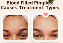 Blood Filled Pimples