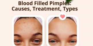 Blood Filled Pimples