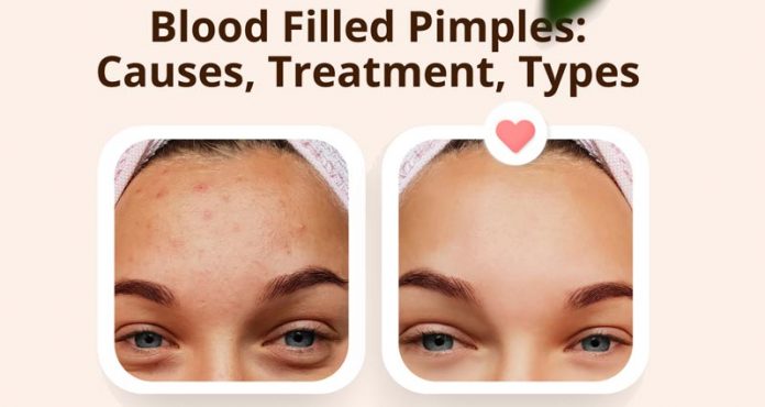 Blood Filled Pimples