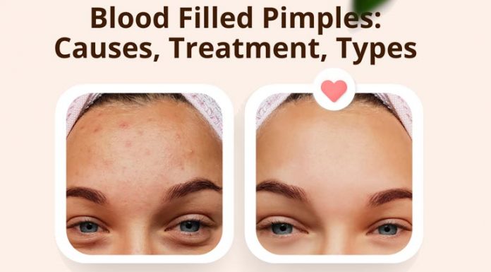 Blood Filled Pimples: Causes, Treatment, and Types Blood Filled Pimples