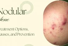 Nodular Acne