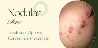 Nodular Acne