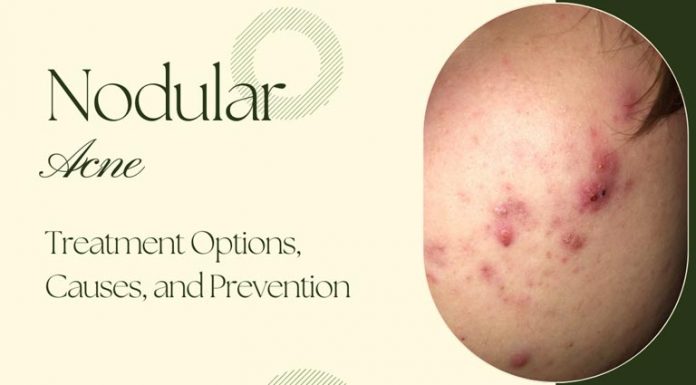 Nodular Acne and Treatment Options: Causes, Prevention Nodular Acne
