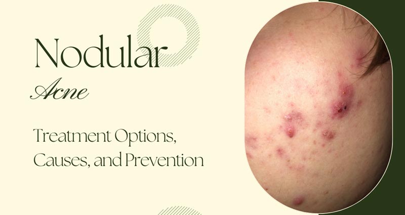 Nodular Acne and Treatment Options: Causes, Prevention