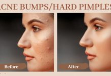 Acne Bumps Hard Pimples