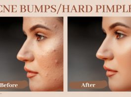 Acne Bumps Hard Pimples