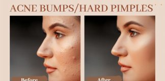 Acne Bumps Hard Pimples
