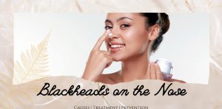 Blackheads on the Nose