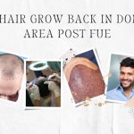 FUE Hair Donor Area