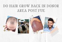 FUE Hair Donor Area