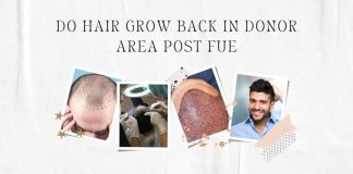 FUE Hair Donor Area