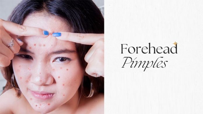 Forehead Pimples Reasons