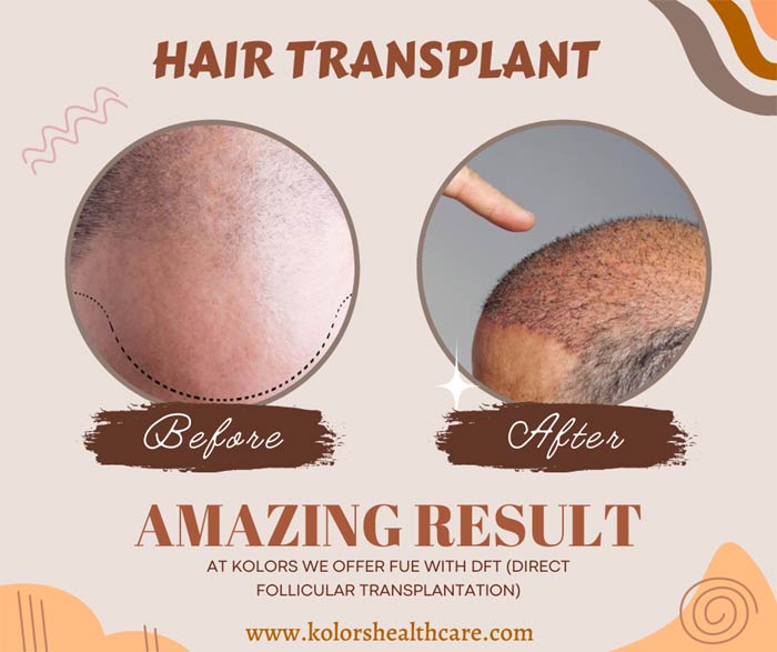 Kolors Hair Transplant Success