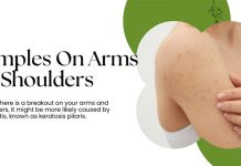 Pimples On Arms Shoulders