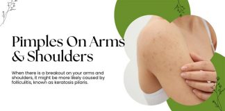 Pimples On Arms Shoulders