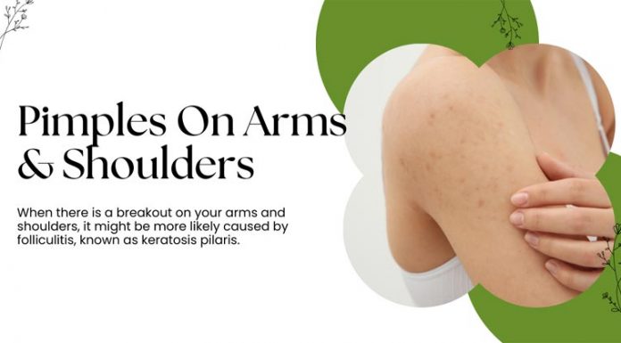 Pimples On Arms Shoulders