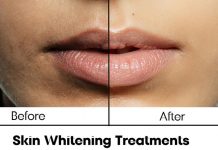 Skin Whitening Treatments