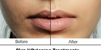 Skin Whitening Treatments