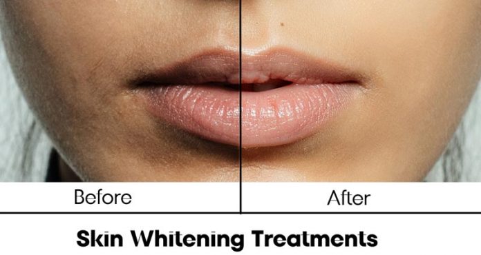 Skin Whitening Treatments