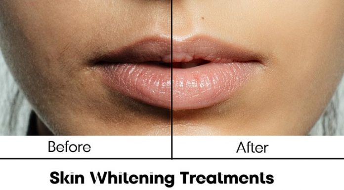 Skin Whitening Treatments