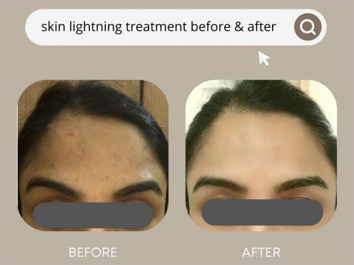Skin Whitening Treatment Cost In India Price Analysis
